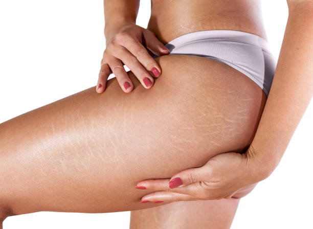 Stretch marks on woman's thighs and buttocks Stretch marks on woman's thighs and buttocks